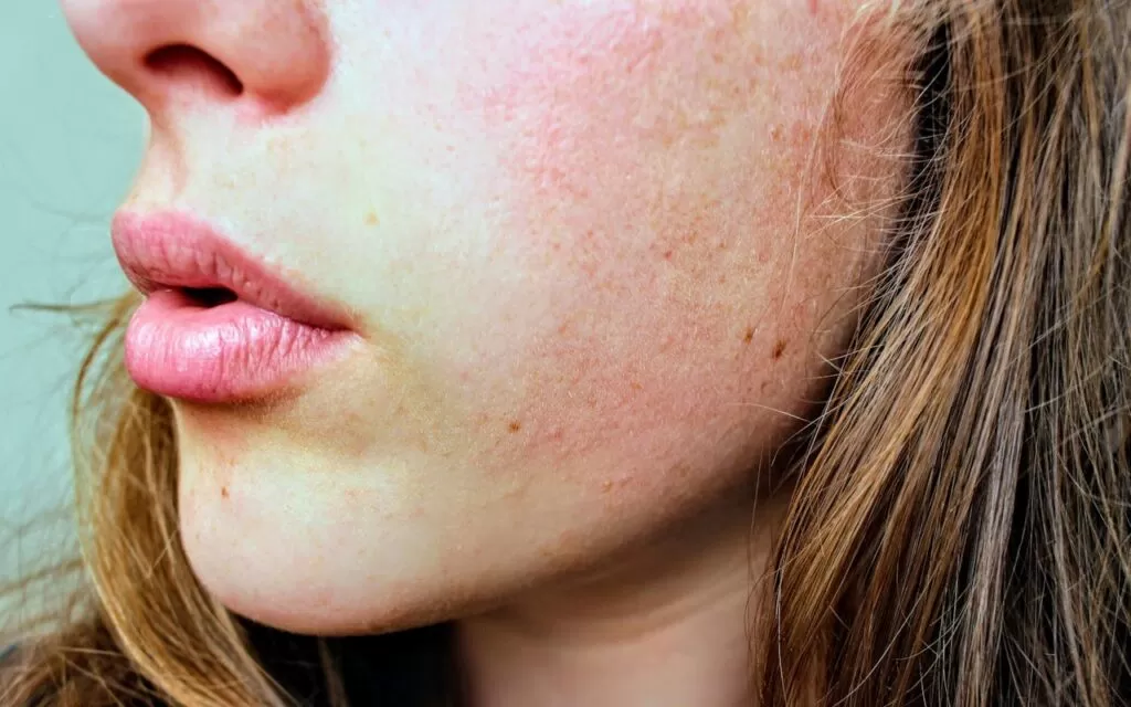 a woman with dry skin